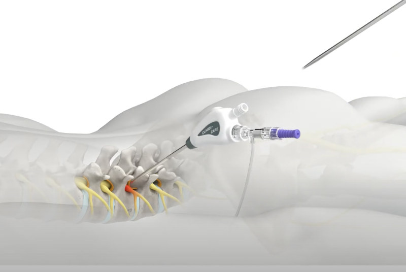 Einführung der Arbeitskanüle entlang des Diletators - VentraCare GmbH