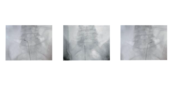 Gepulste ganglionäre Radiofrequenz - VentraCare GmbH